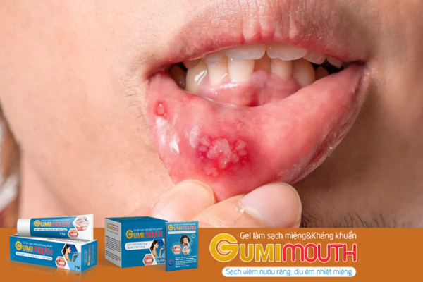 Tại sao nên dùng Gumimouth cho người viêm loét miệng?